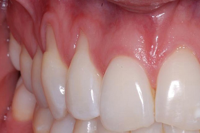Diş Eti Hastalığı Nedir?