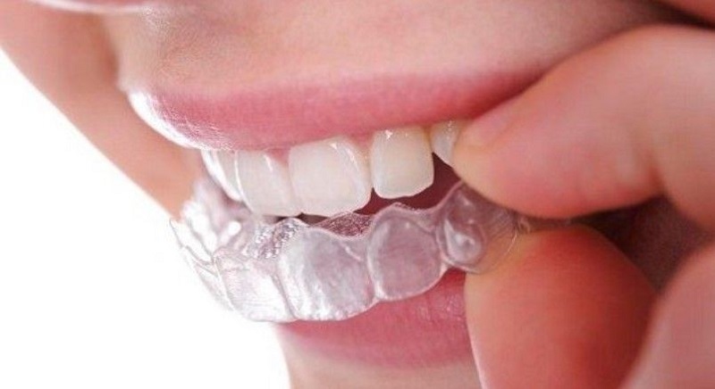 Diş Gıcırdatmasının Nedenleri Nelerdir?