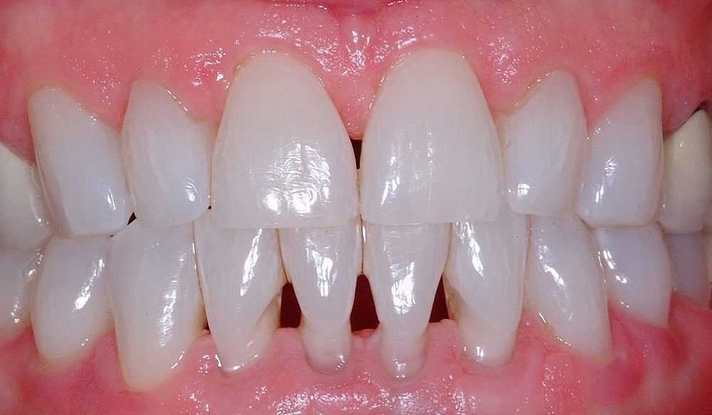 Diş İmplantlarına Zarar Verecek Zararlı Alışkanlıklar