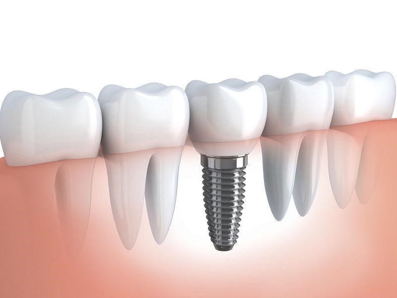 İzmir En İyi Diş implantı