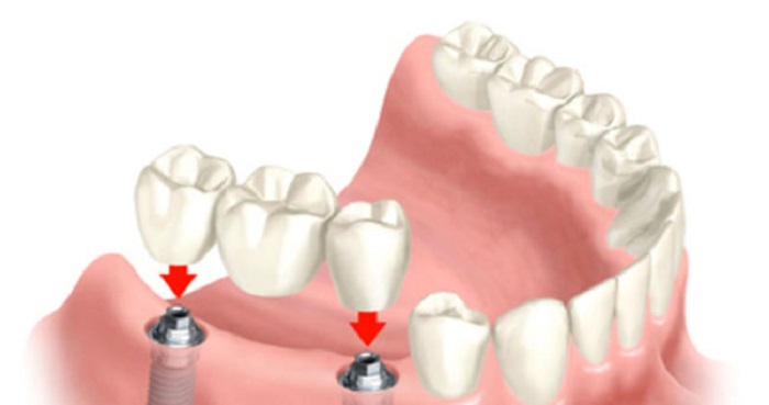 İzmir Diş İmplantı Kaç Dişe Yapılır?