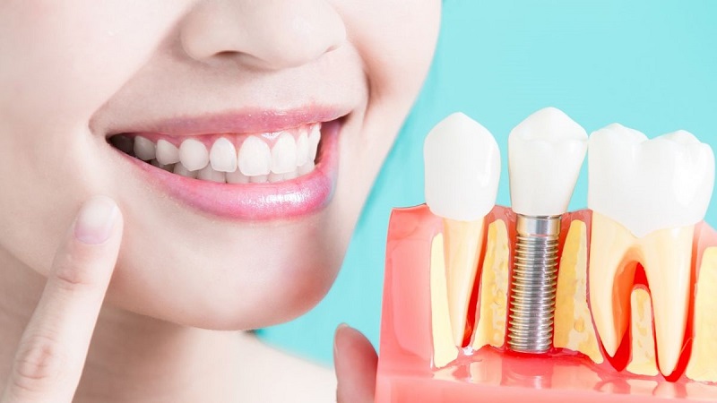 İzmir Diş İmplantı Yaptırmak Güvenli mi?